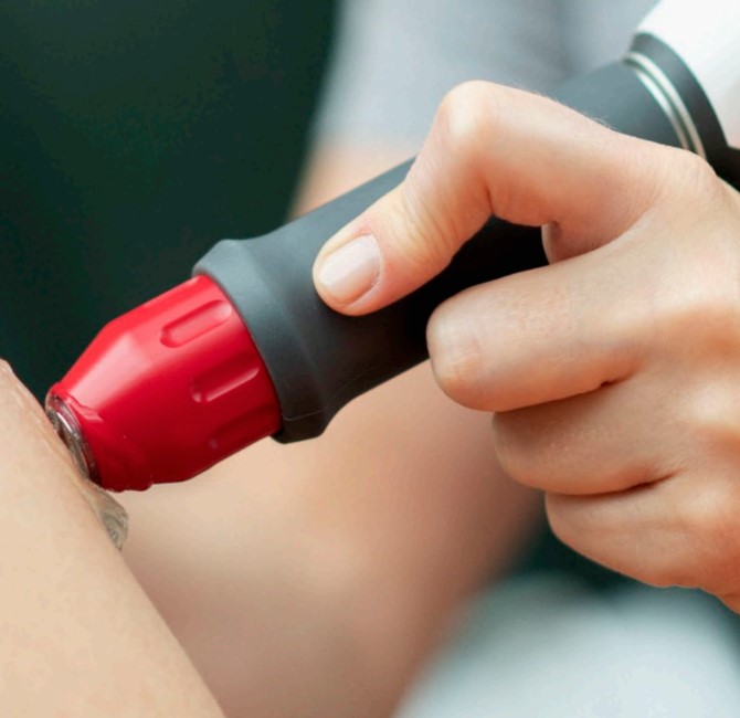 Shockwave therapy for heel pain at Cockburn Podiatry